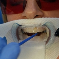 Wybielanie zębów bez bólu - czy to możliwe?