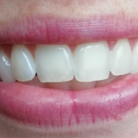 Wybielanie zębów bez bólu - czy to możliwe?